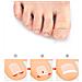 Toppe Per La Correzione Delle Dita Dei Piedi Benda Per La Correzione Delle Unghie Incarnite - Foto miniatura 5