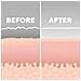 Remove Microdermabrasion - Foto miniatura 4
