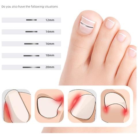 Set Di Cerotti Correttivi Per Unghie Incarnite - 10 Cerotti  20mm - Foto 2