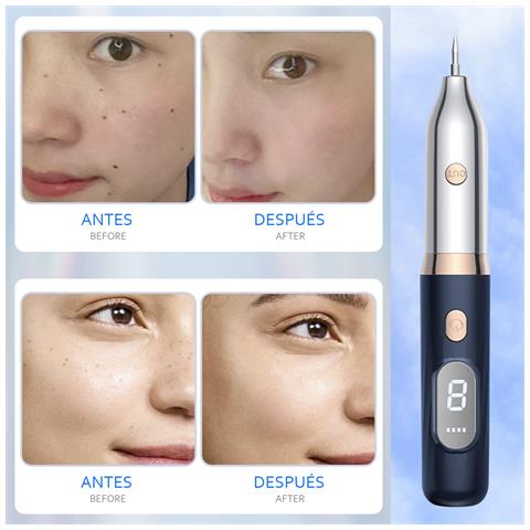 Penna Per Nevo. Per Lentiggini, Placche Senili, Nevi Piatti, Ecc. 2,8x2,8x19 Cm. Color Argento - Foto 6