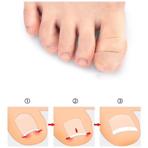Toppe Per La Correzione Delle Dita Dei Piedi Benda Per La Correzione Delle Unghie Incarnite - Foto 5
