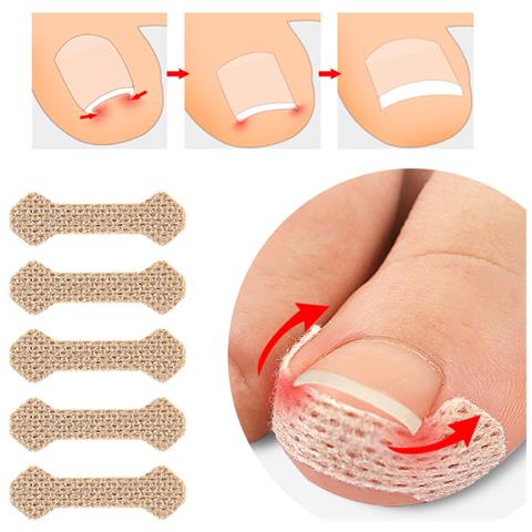 Cerotto Per Unghie Incarnite Beige - Foto 1