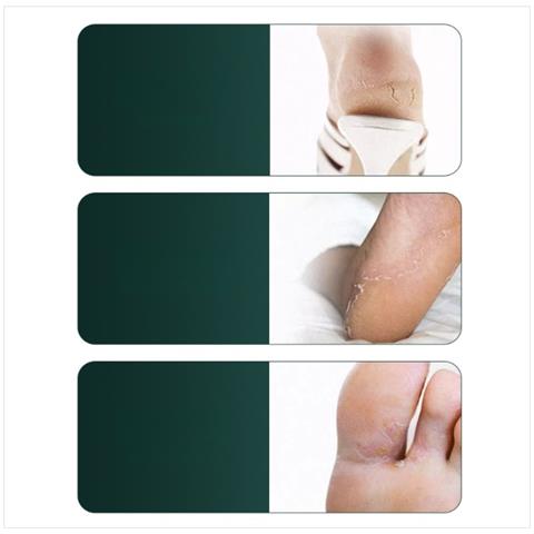 Set Di Coltelli Per Pedicure A Scacchi Argentati (5 Pz) - Strumenti Professionali Per La Cura Delle Unghie Incarnite E Dei Piedi - Foto 2