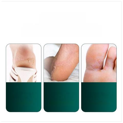 Set Di Coltelli Per Pedicure A Scacchi Argentati (5 Pz) - Strumenti Professionali Per La Cura Delle Unghie Incarnite E Dei Piedi - Foto 3