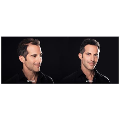 Hairline optimizer - Foto 4