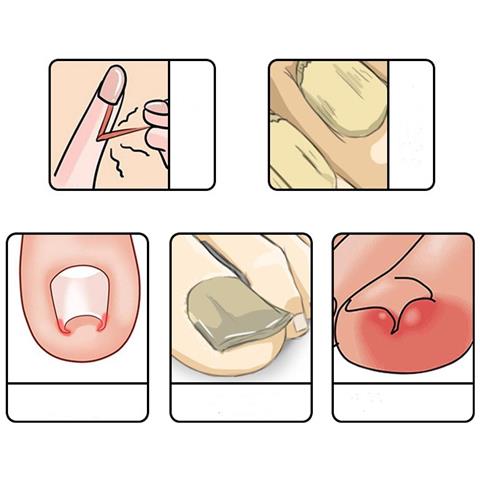 Forbici Specializzate Per Cuticole Con Pinzetta A Becco D'aquila A Molla Incorporata D'argento - Foto 5