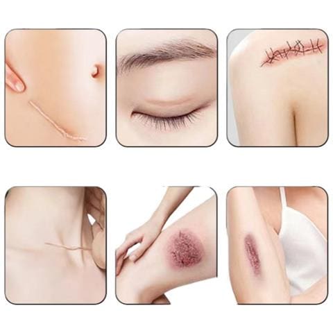 Strisce In Silicone Per Cicatrici - 2 Rotoli Di Nastro Color Pelle Per Trattamento Cicatrici M - Foto 5