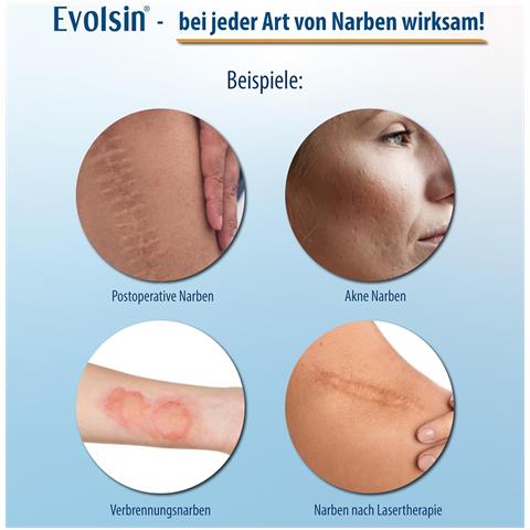 Nastro Per Cicatrici - Fogli Di Silicone Per Cicatrici Matte Transparent Color 3m - Foto 6