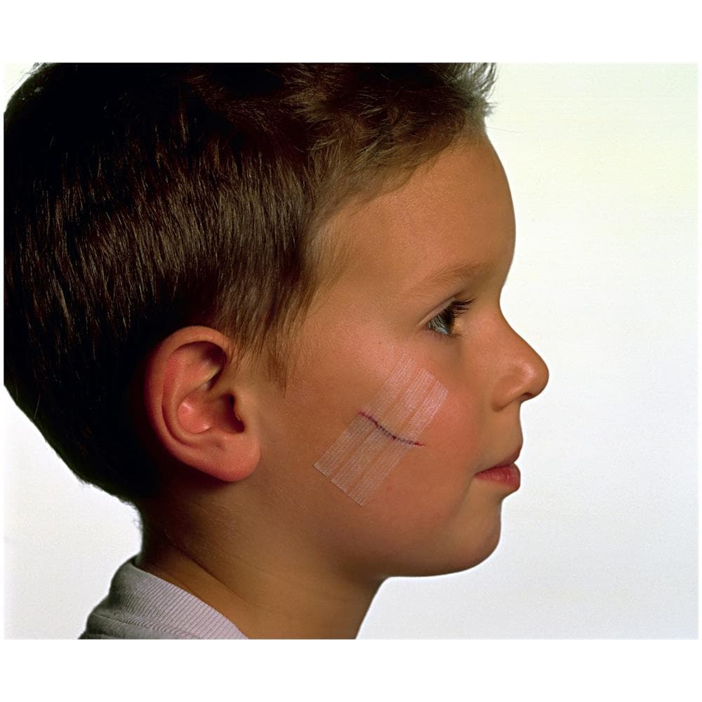 Cerotto per Sutura Nexcare Steristrip 6X75 mm + 3X75 mm - Foto 1